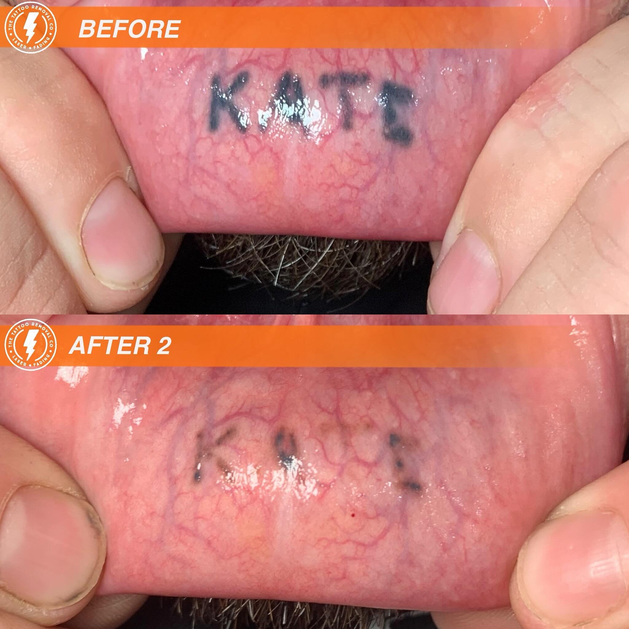 BEFORE/AFTER 2 TREATMENTS💥

This left a sour taste 😝

⚡️Fabulous result so far. These are the results you get with our experienced and knowledgeable Laser Technician @philly_ttrc_pagdin ⚡️

Consultations are FREE please don&rsquo;t hesitate to cont