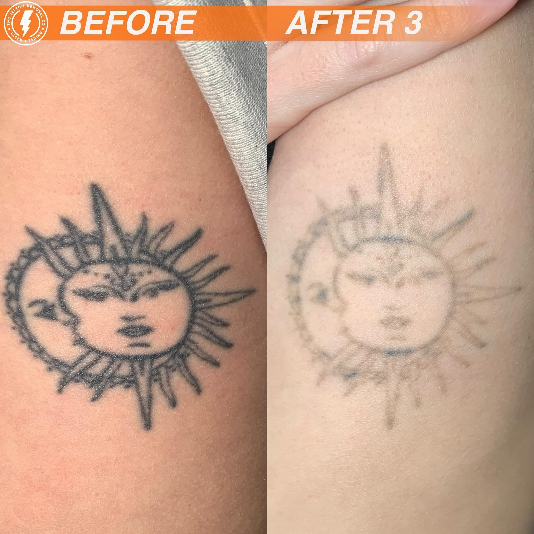 BEFORE/AFTER 3 TREATMENTS💥

Day or Night ain&rsquo;t got nothing on us 🌗

⚡️Fabulous result so far. These are the results you get with our experienced and knowledgeable Laser Technician @philly_ttrc_pagdin ⚡️

Consultations are FREE please don&rsqu