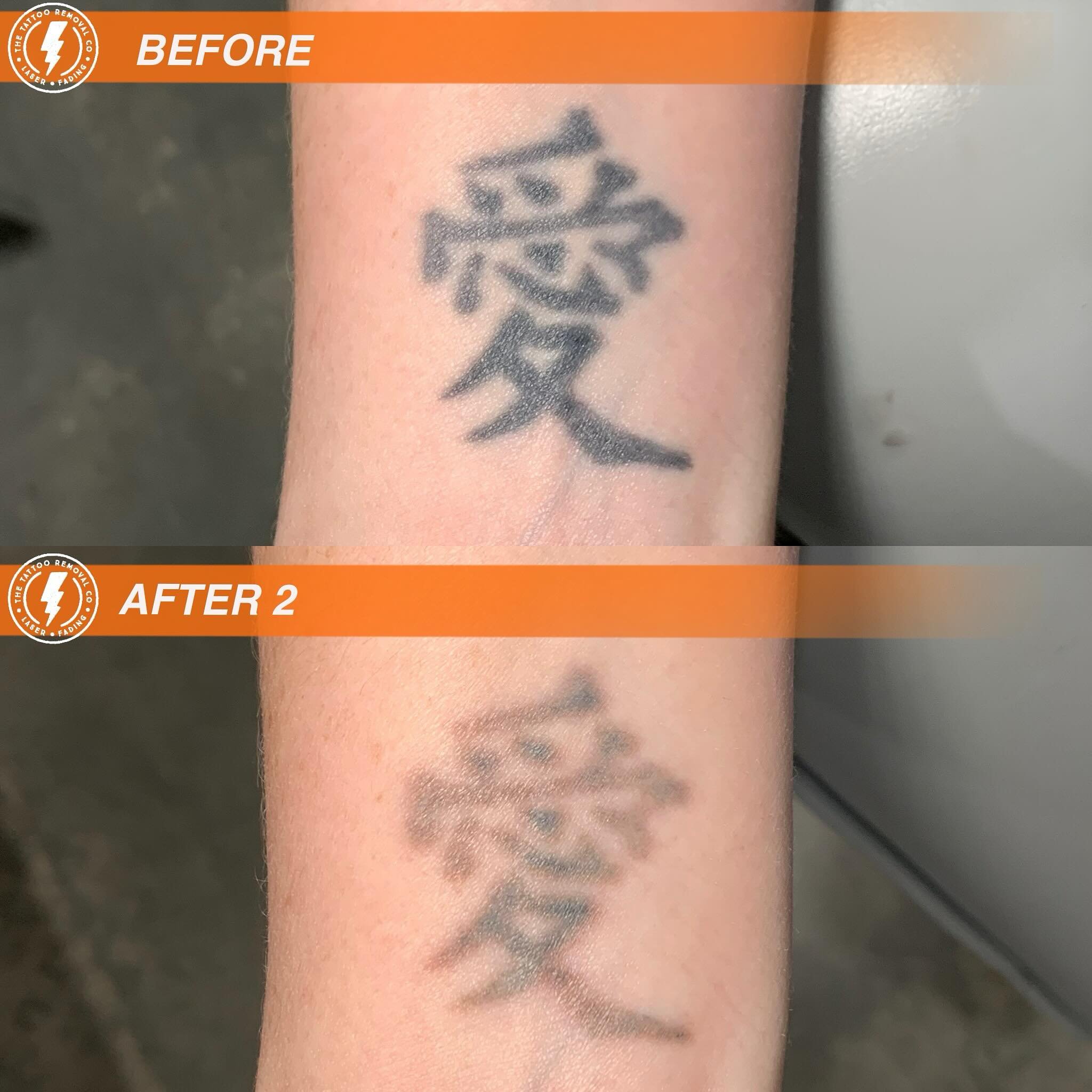 BEFORE/AFTER 2 TREATMENTS💥

As simple as a symbol ⚡️

⚡️Fabulous result so far. These are the results you get with our experienced and knowledgeable Laser Technician @philly_ttrc_pagdin ⚡️

Consultations are FREE please don&rsquo;t hesitate to conta