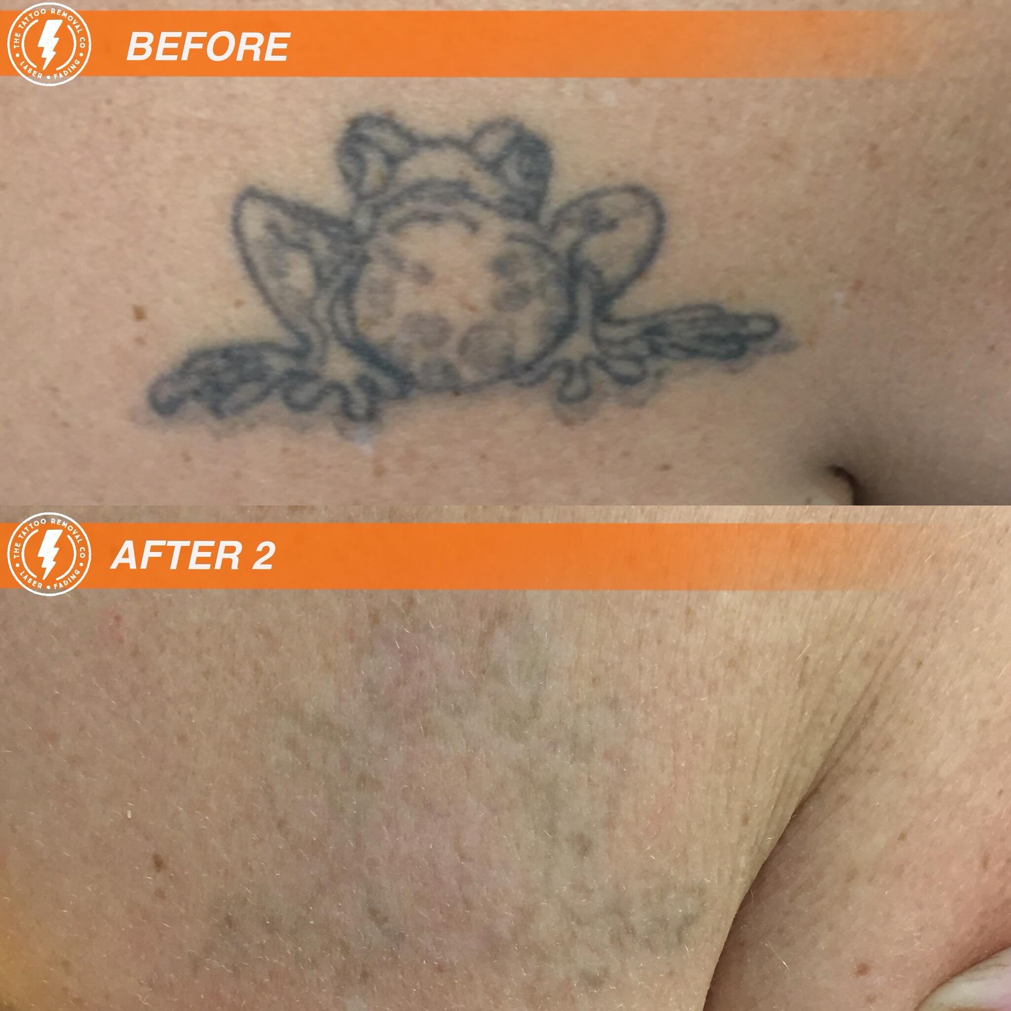 BEFORE/AFTER 2 TREATMENTS💥

We really rrrrriiiiibbbbit that one 🐸

⚡️Fabulous result so far. These are the results you get with our experienced and knowledgeable Laser Technician @philly_ttrc_pagdin ⚡️

Consultations are FREE please don&rsquo;t hes