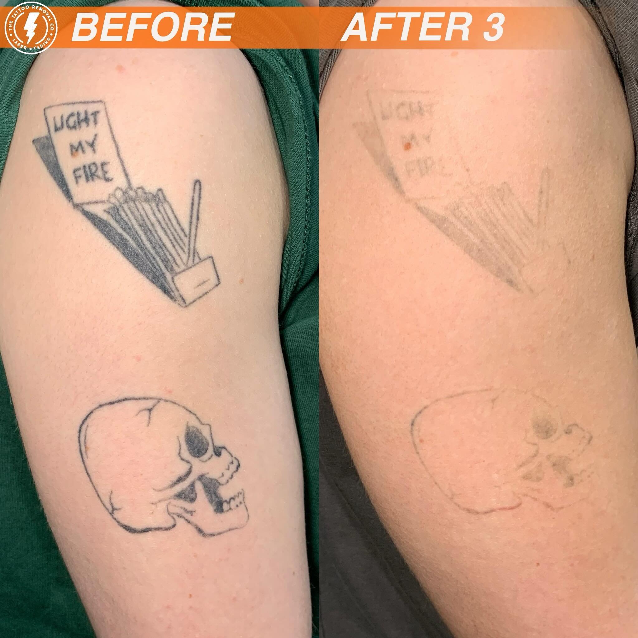 BEFORE/AFTER 3 TREATMENTS💥

⚡️Fabulous result so far. These are the results you get with our experienced and knowledgeable Laser Technician @philly_ttrc_pagdin ⚡️

Consultations are FREE please don&rsquo;t hesitate to contact us to organise.

🏠 106