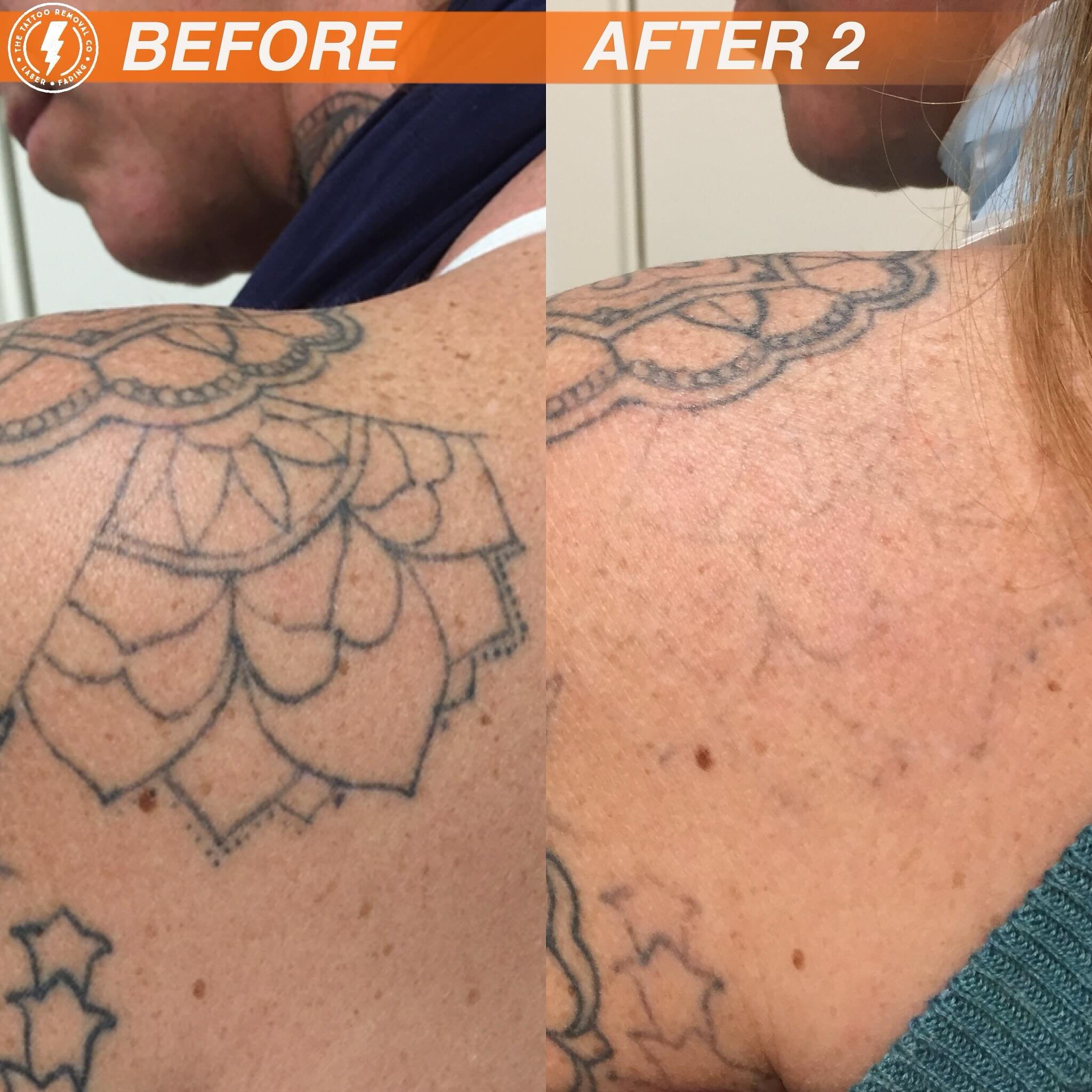 BEFORE/AFTER 2 TREATMENTS💥

Tough shoulders make easy work

⚡️Fabulous result so far. These are the results you get with our experienced and knowledgeable Laser Technician @philly_ttrc_pagdin ⚡️

Consultations are FREE please don&rsquo;t hesitate to