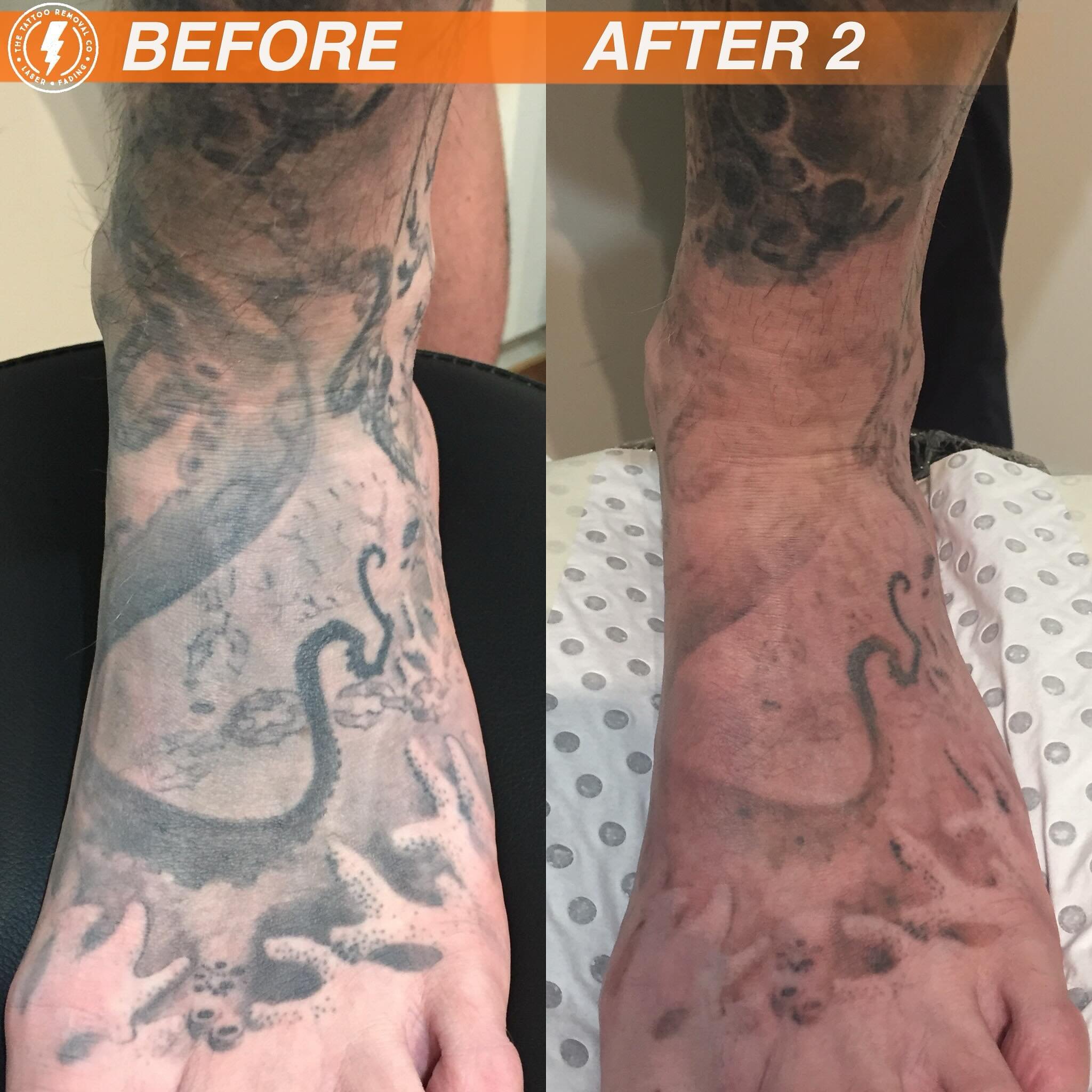 BEFORE/AFTER 2 TREATMENTS💥

Oohhh Aaaarrrrrr it&rsquo;s the kraken 🦑

⚡️Fabulous result so far. These are the results you get with our experienced and knowledgeable Laser Technician @philly_ttrc_pagdin ⚡️

Consultations are FREE please don&rsquo;t 