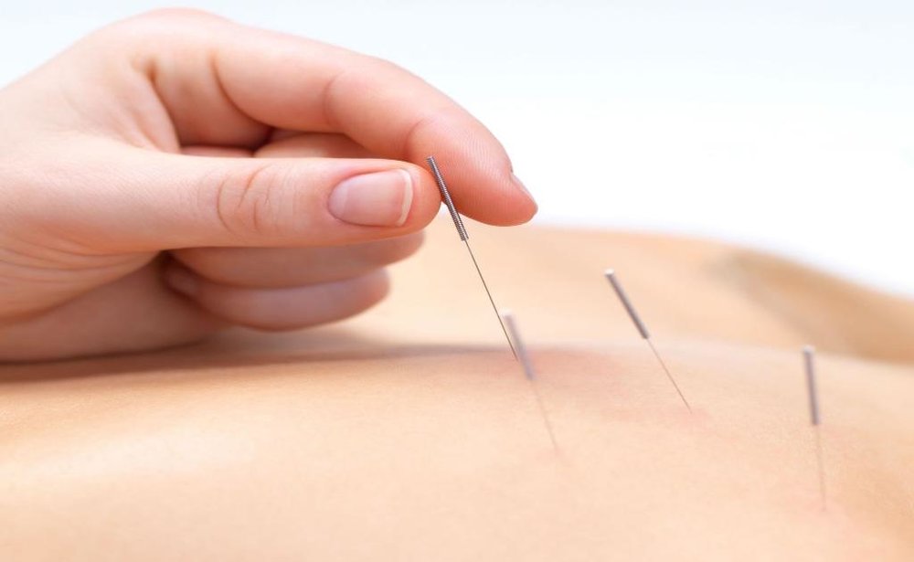 Managing Stress with the Power of Acupuncture: Discover the Calming Effects of this Ancient Practice