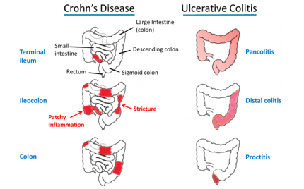 Brilacidin for IBD—A Promising Novel, Non-Corticosteroid, Non-Biologic Drug Candidate