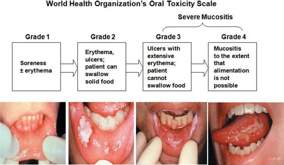 Brilacidin for the Prevention of Severe Oral Mucositis
