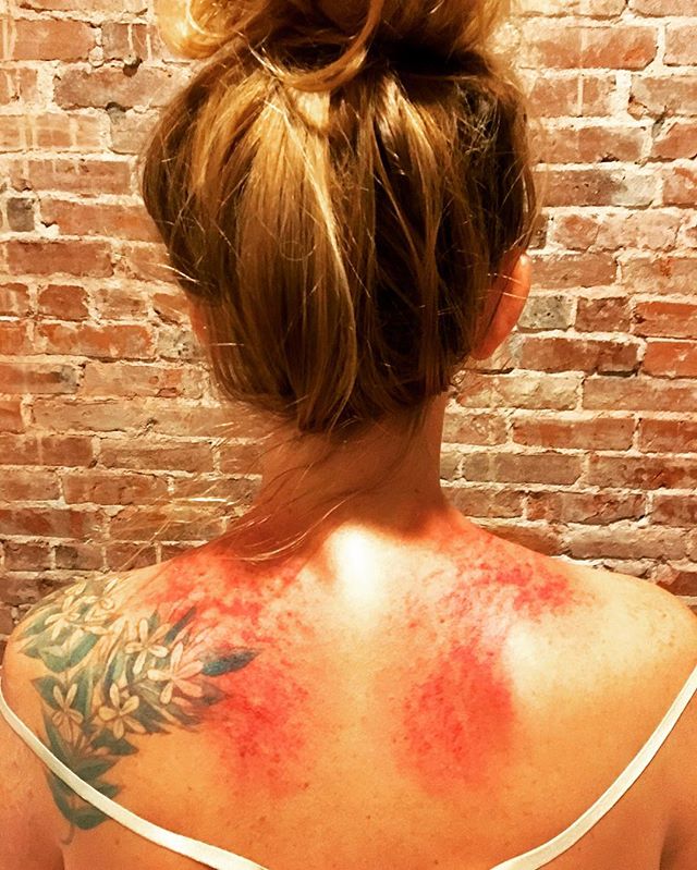 A beautiful example of how a treatment can help diagnose. When we use Gua Sha and cupping as tools the markings left on the body yield more data about a patient's condition. A few weeks of neck tension created a lot of blood stasis, without an underl