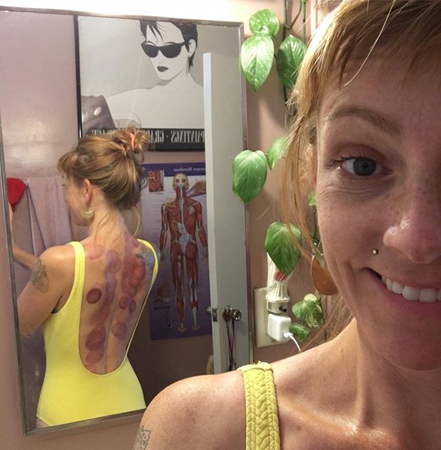 When you say yes to a beach day forgetting your back looks like this 🤷🏼&zwj;♀️ 😬. I also get needles for aches and pains but sometimes just need my entire back cupped. Had so much muscle tension from running plus travel body...
Honestly I was a li