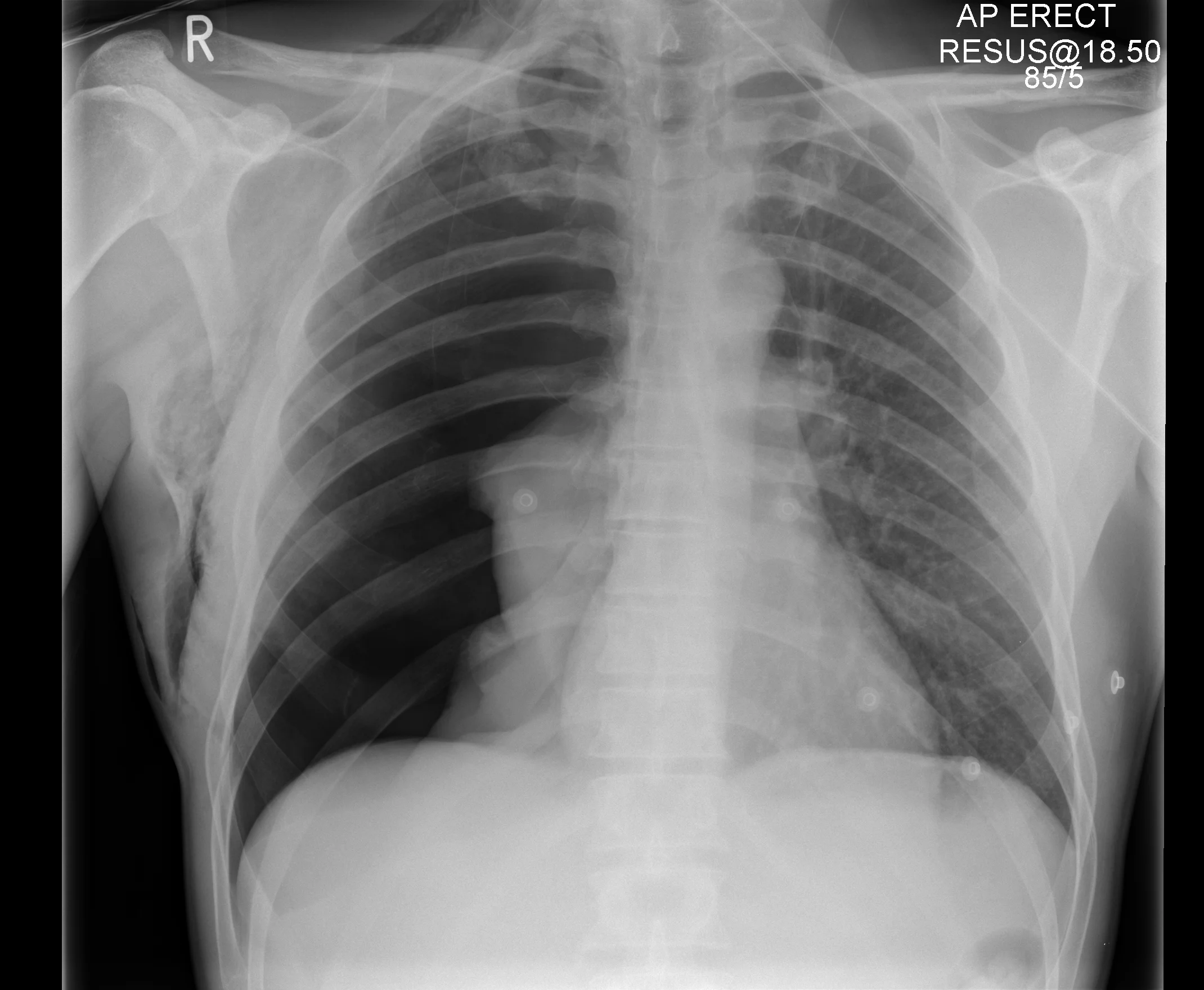 CXR ap - breathless Don't worry - they're not this easy on the day!