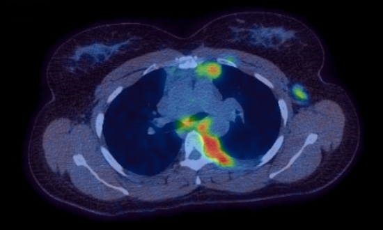 CT-PET fusion axial - weight loss That's more like it! (This is one of the easier ones too...)