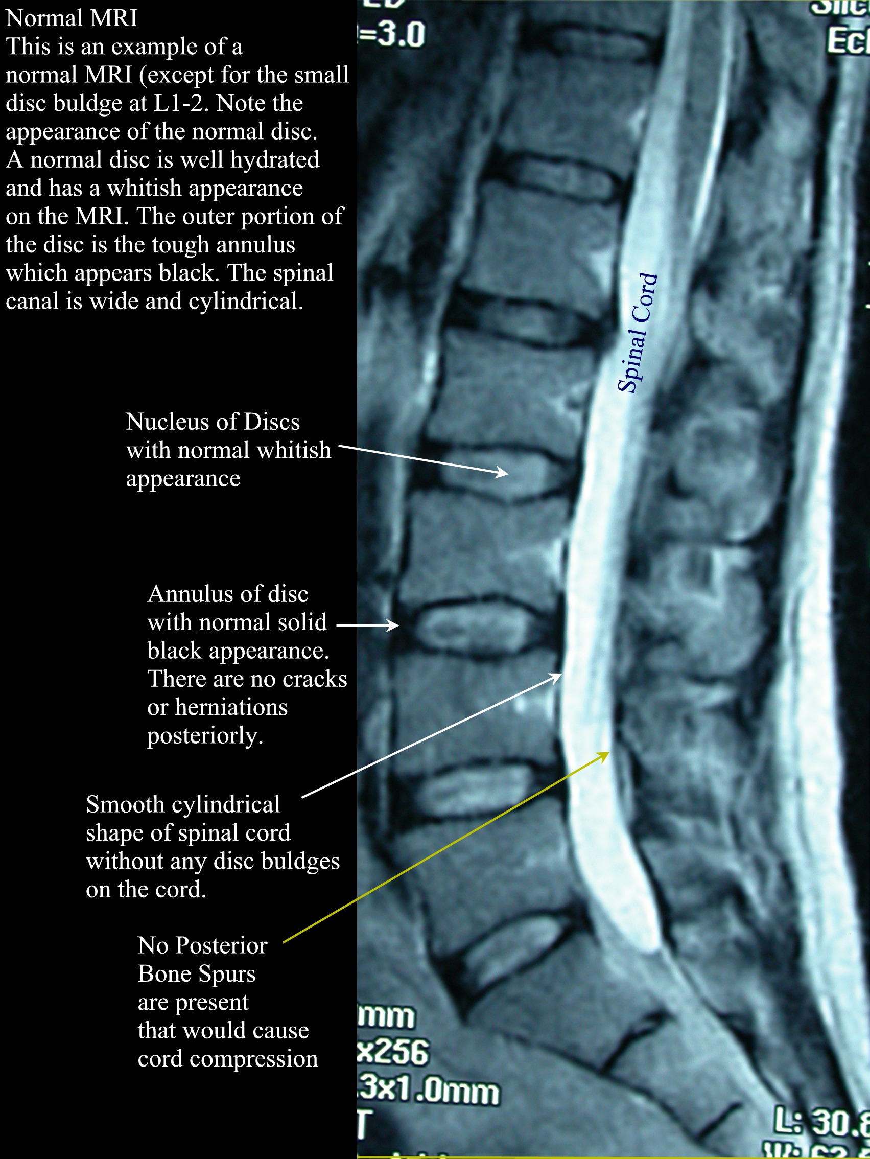 lumbar spine image
