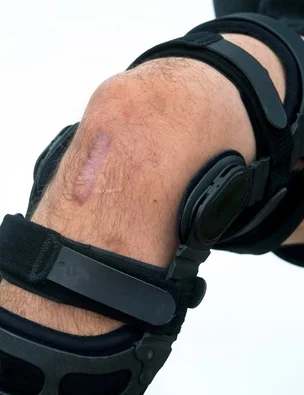 Why are ACL’s Tearing Left and Right?