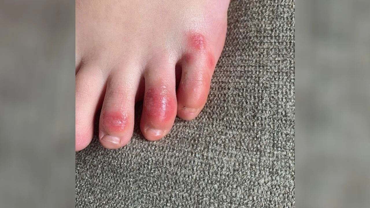 Covid-Toe: An unseen symptom of Coronavirus?