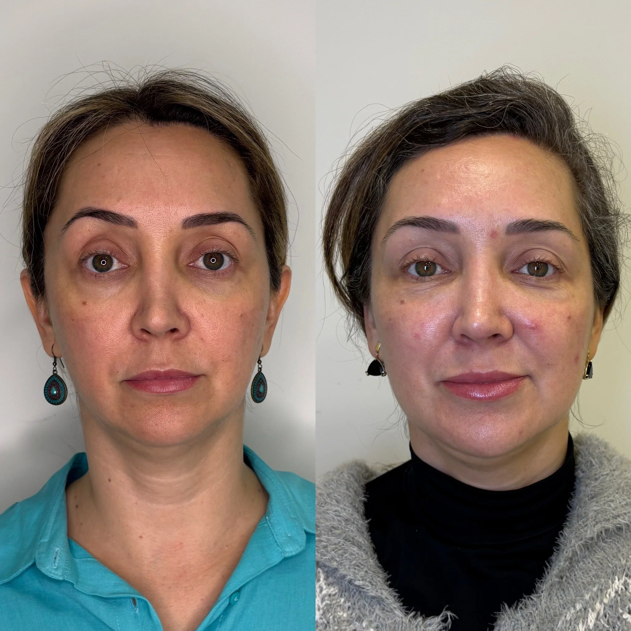 Antes e depois de harmonização facial com foco em contorno e naturalidade em Curitiba.
