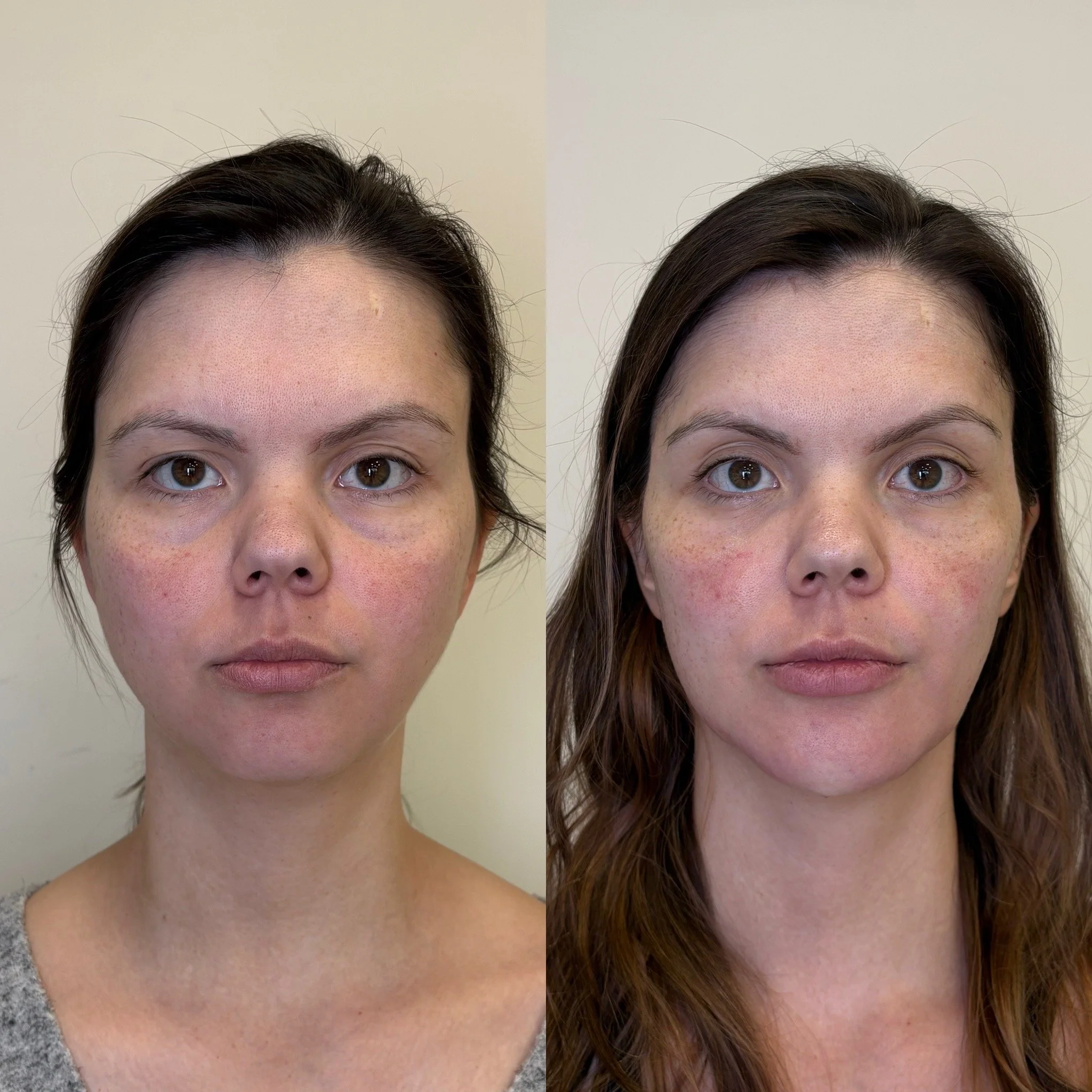 Antes e depois de harmonização facial com foco em contorno e naturalidade em Curitiba.