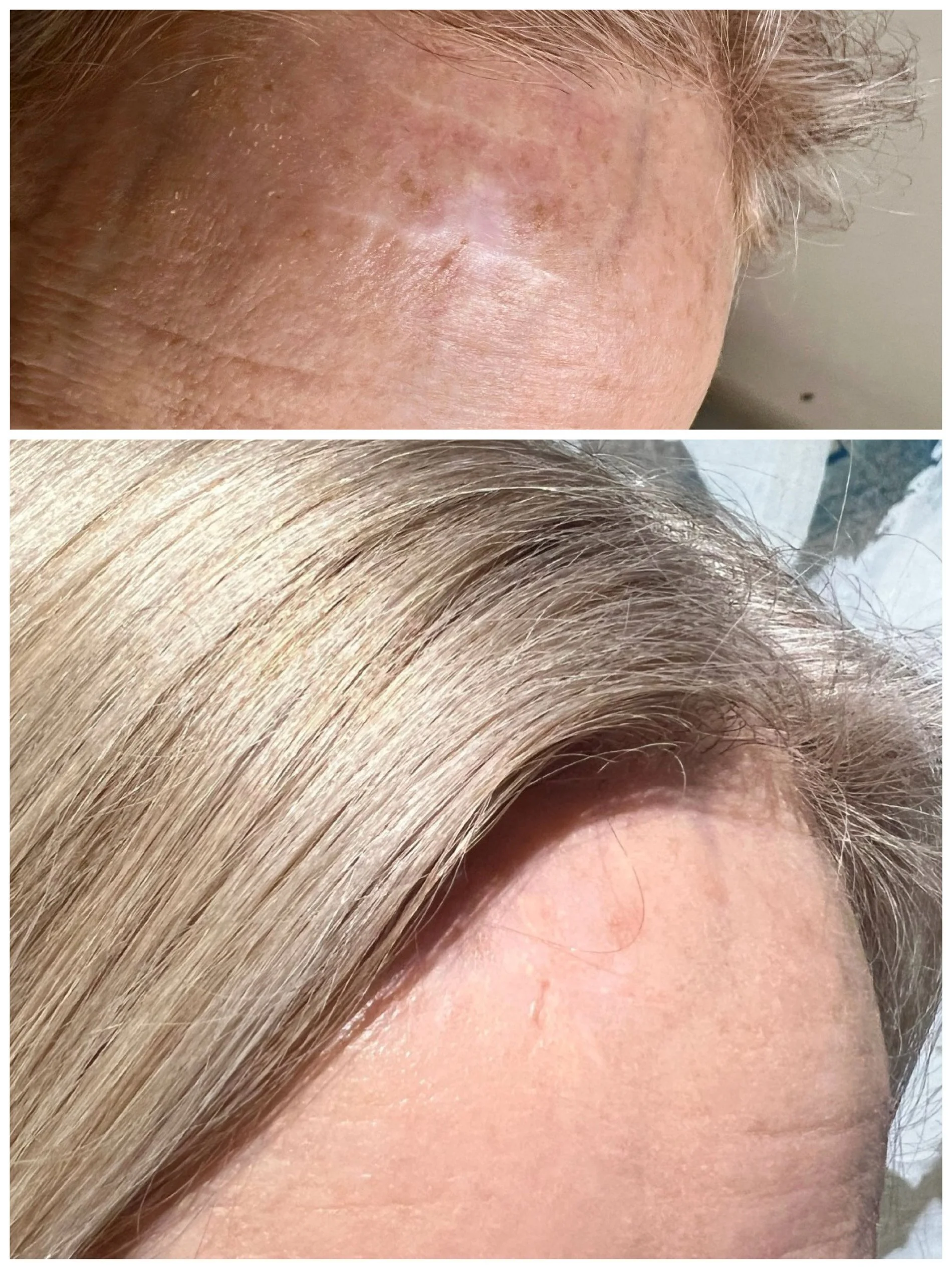 Close-up comparison of a person's forehead before and after scar camouflage treatment. The top image shows a forehead with a large white scar. The bottom image shows the same forehead with the scar barely visible following tattoo repigmentation.