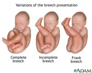 breech, frank breech, birth story, 34 weeks pregnant