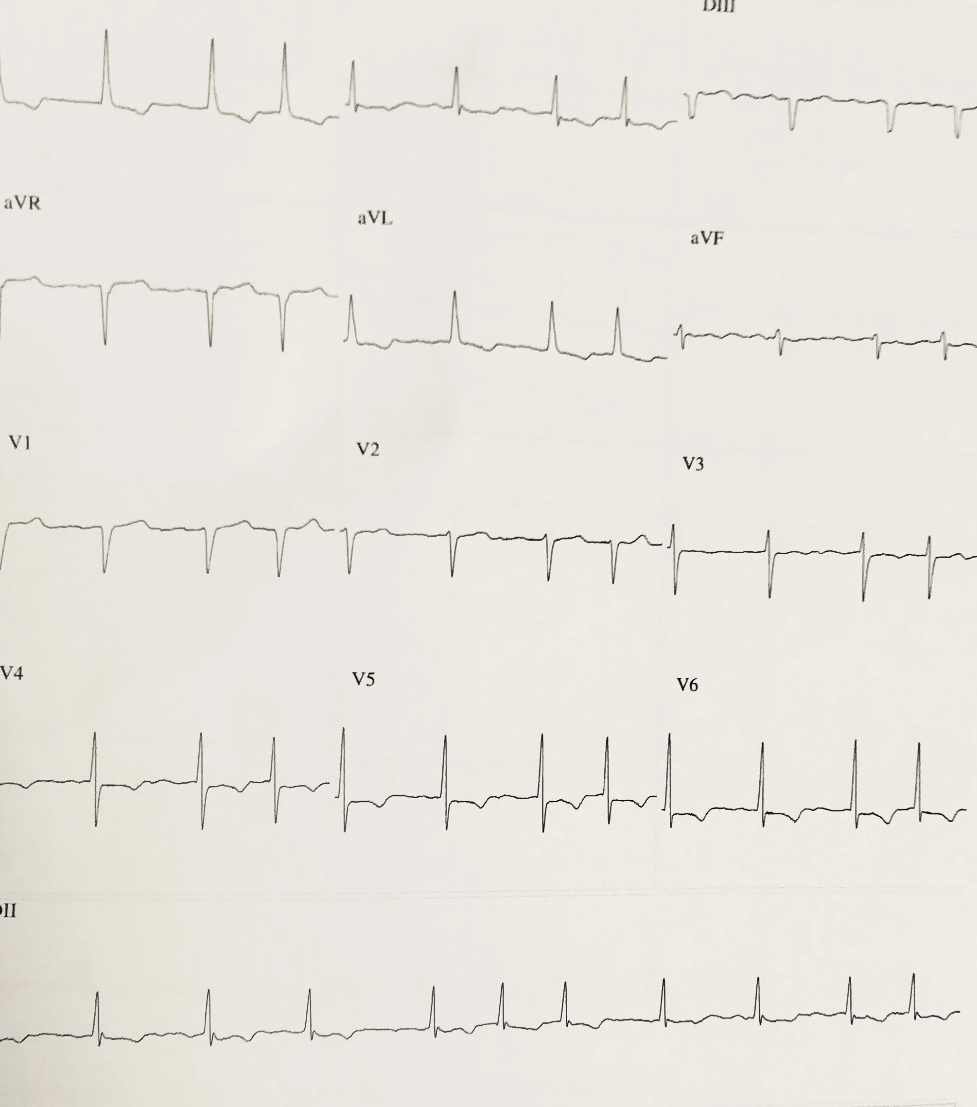Fibrilação Atrial 10 Mudanças no Estilo de Vida que Reduzem a Recorrência da Arritmia — Cardio