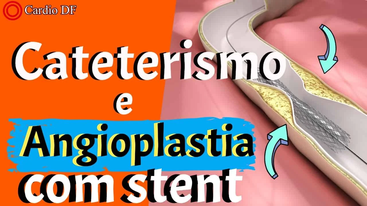 Angioplastia Coronariana e Colocação de Stents - Tire suas dúvidas!