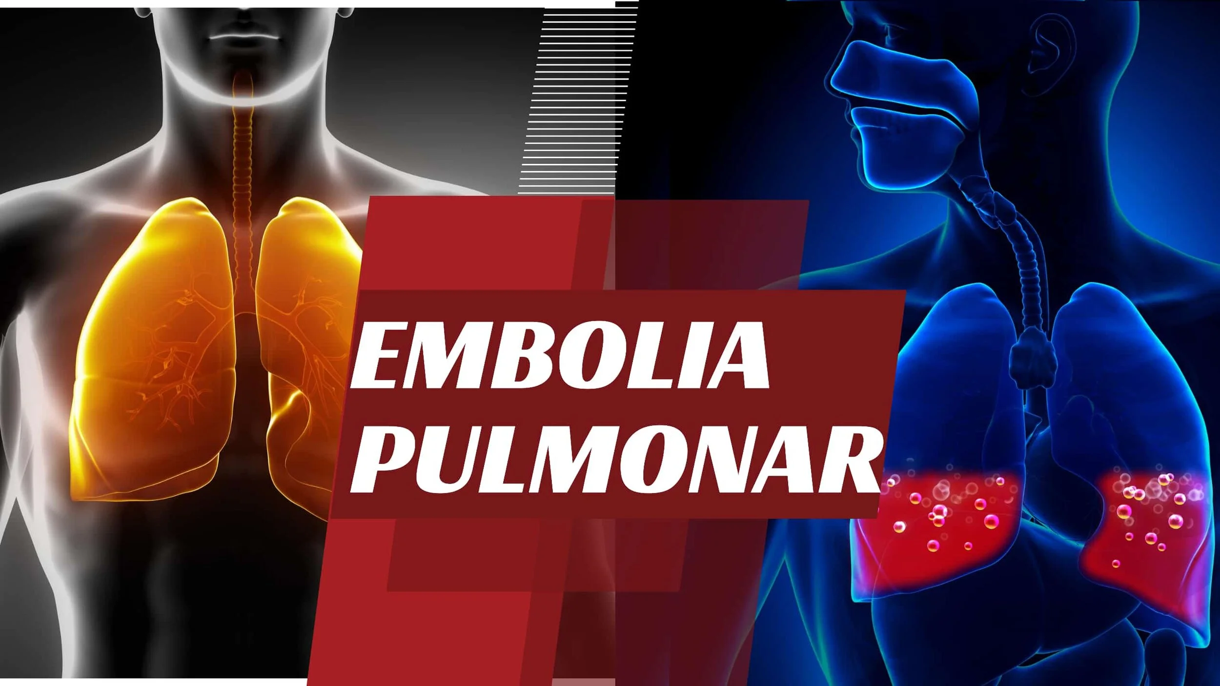 Embolia Pulmonar | Sintomas, Causas e Tratamento | Dr Andre Wambier