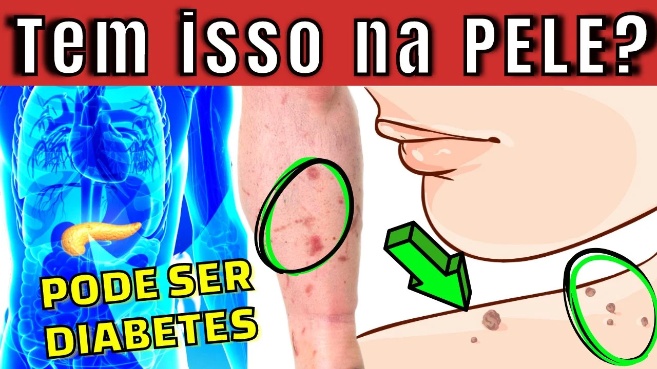 10 PRINCIPAIS SINAIS de DIABETES na PELE! (aparecem se você tem MUITO AÇÚCAR no sangue)