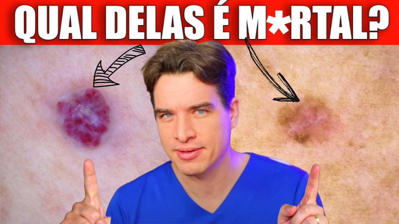 Pinta ou MELANOMA? Saber a diferença pode salvar sua vida!