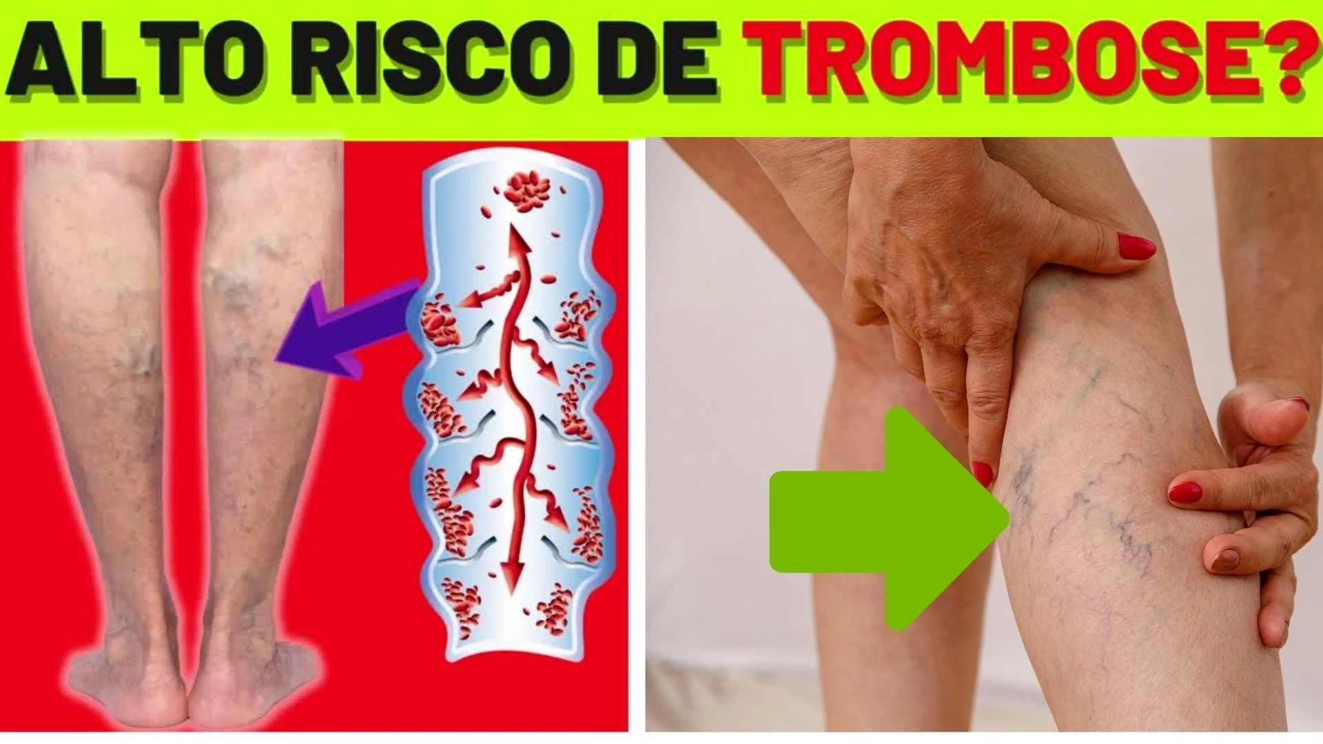 COMO MELHORAR a CIRCULAÇÃO e SE LIVRAR das VARIZES NAS PERNAS (e evitar trombose)