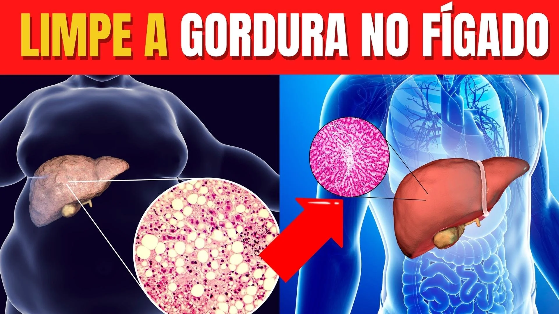 COMO LIMPAR A GORDURA NO FÍGADO: os 5 MELHORES ALIMENTOS PARA REVERTER ...