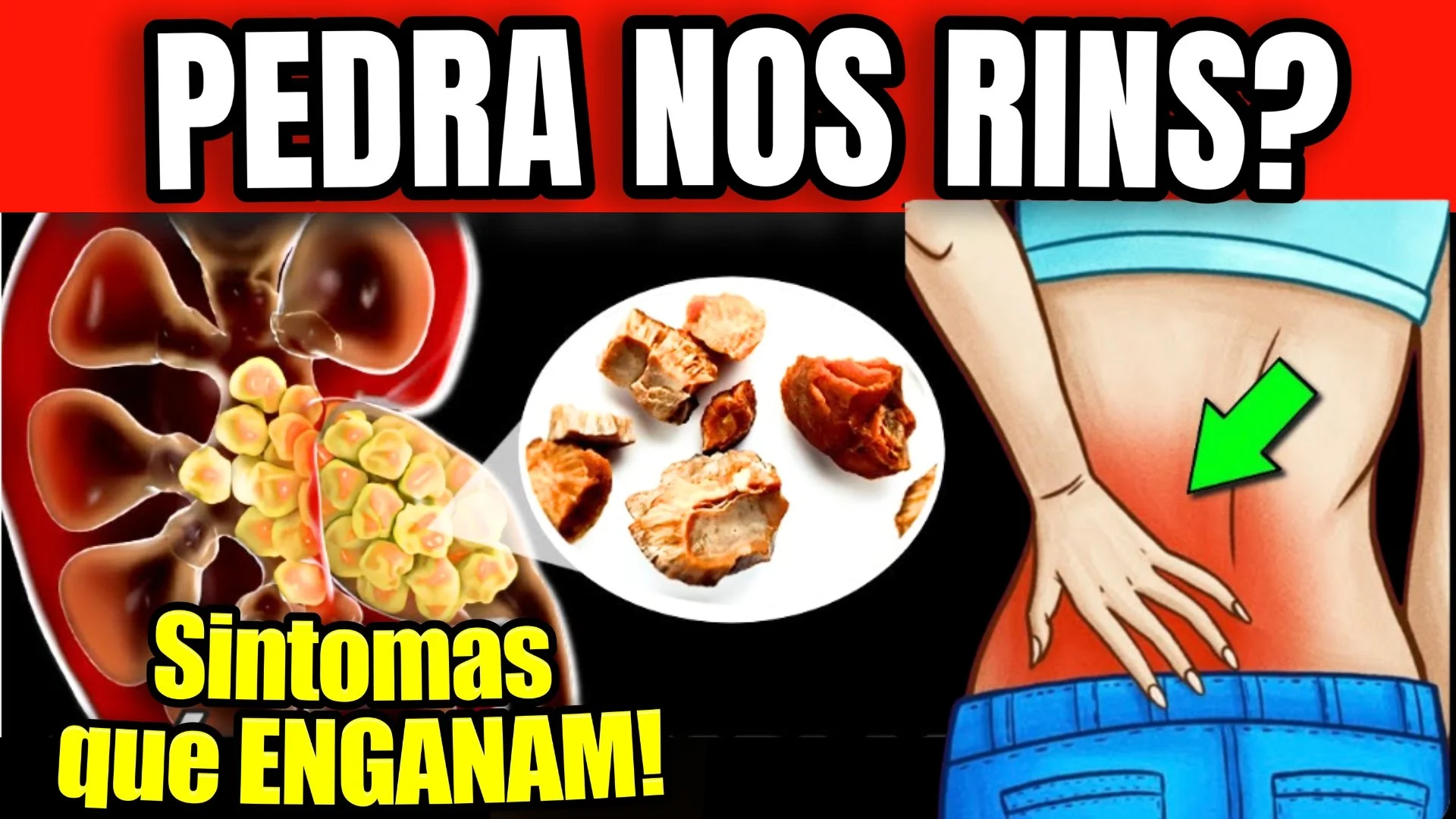 ALERTA MÁXIMO: 4 Sinais de PEDRA no RIM PRESA (Que Leva à HEMODIÁLISE!) | A MELHOR Solução Natural