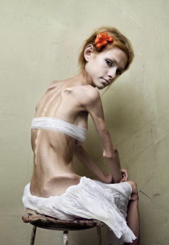 bulimia-anorexia.jpeg
