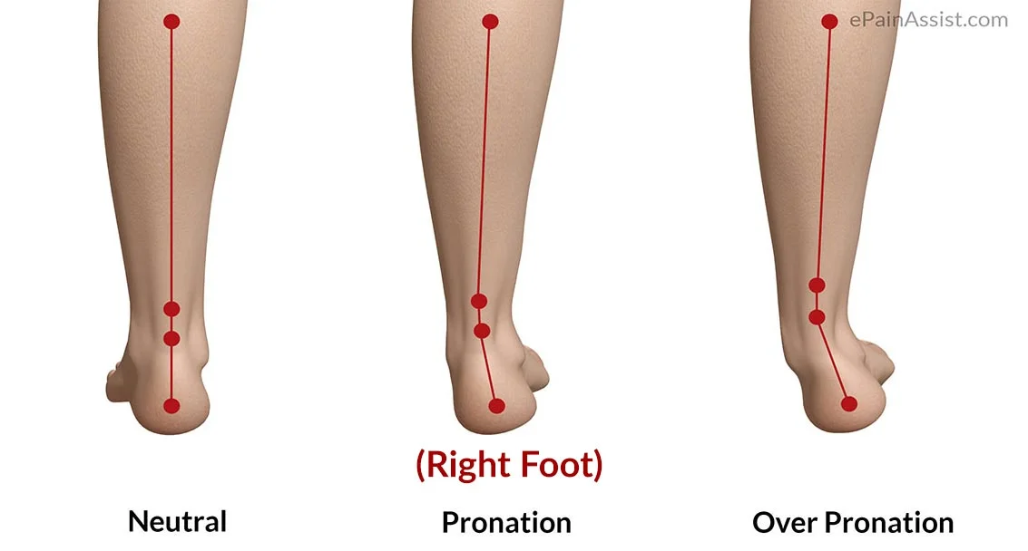 OVER PRONATED FEET