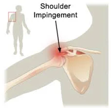 shoulderimpingement.jpeg