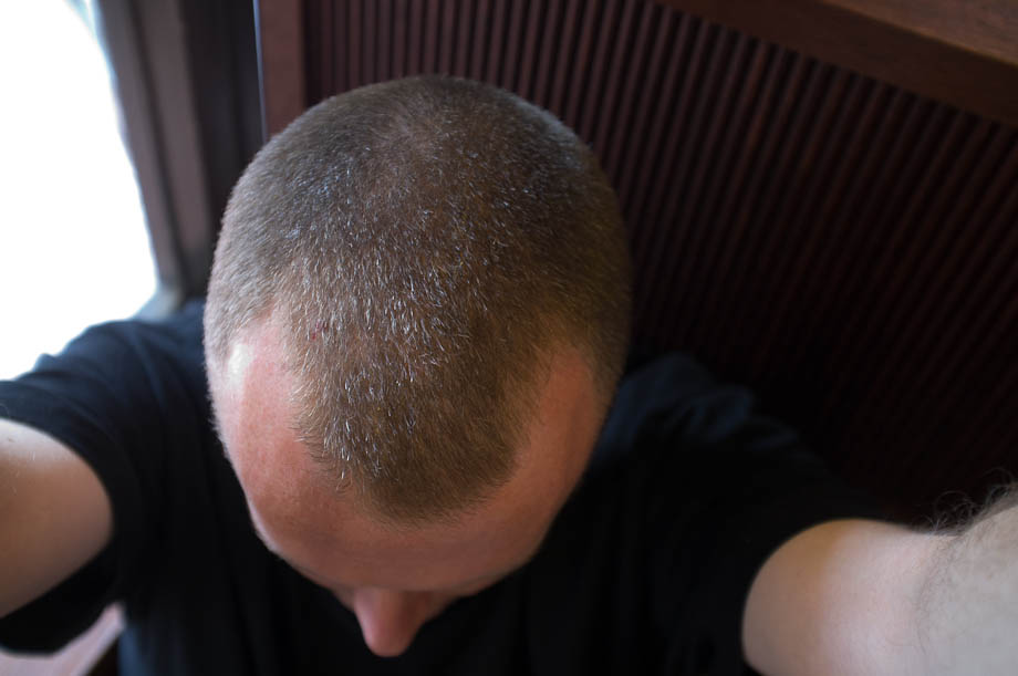 Mail Pattern Baldness