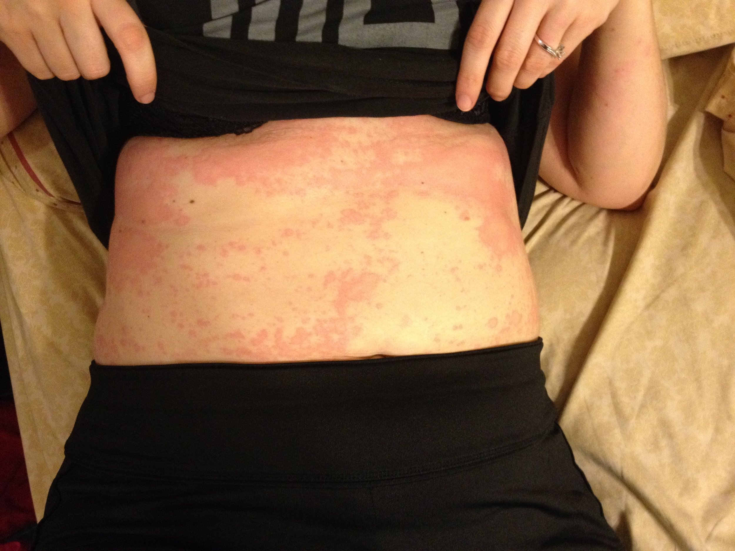 Here are hives on my stomach. This was a different time from the ones on my legs. The hives could occur anywhere...