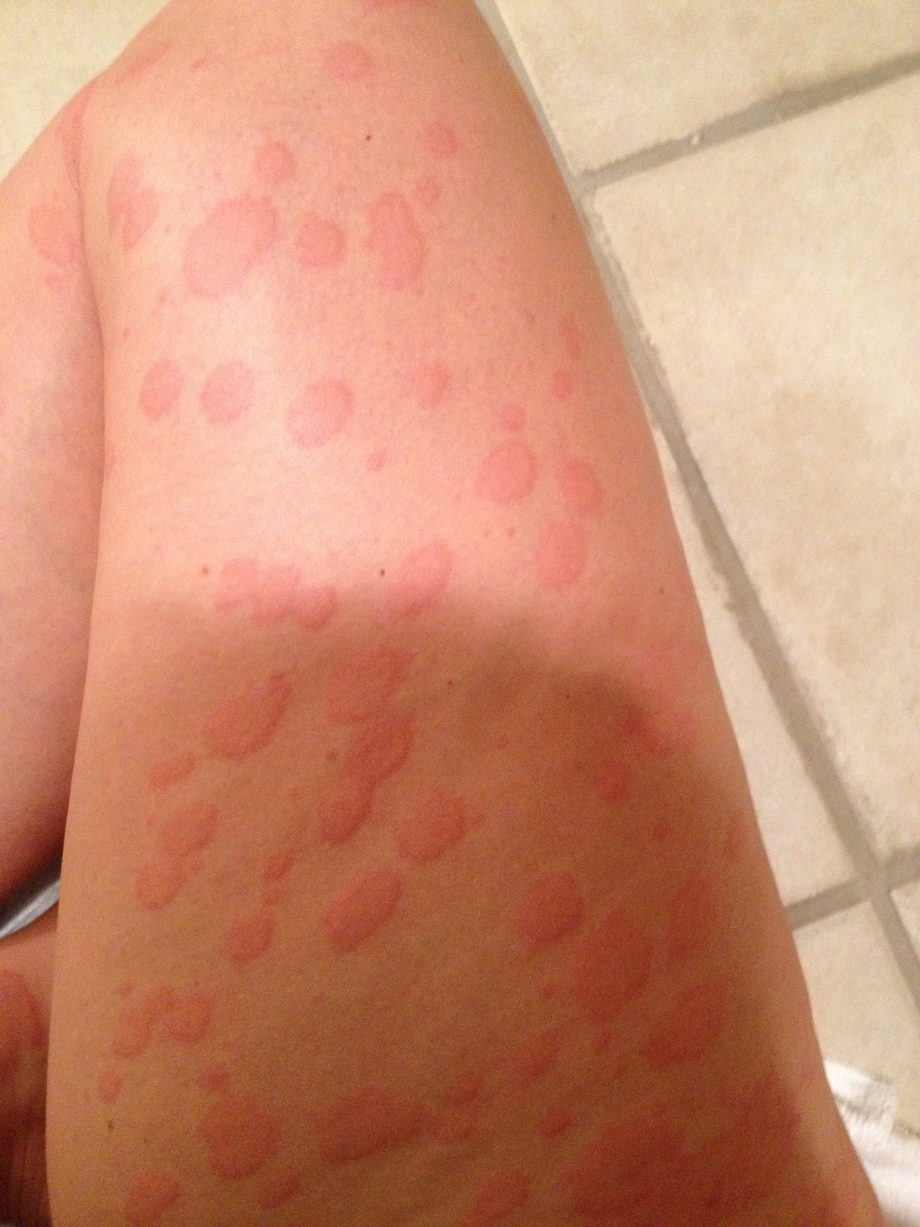A typical episode of hives for me on my inner and upper thighs.