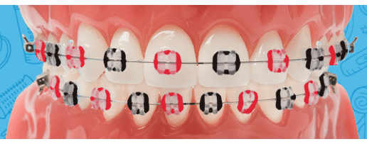 orthodontictiesonbraces