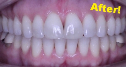 This patient was treated in our office with 15 months of Clear Aligner Therapy (Invisalign).