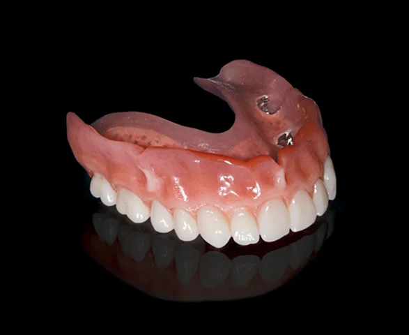 IMPLANT-SUPPORTED REMOVABLE DENTURE