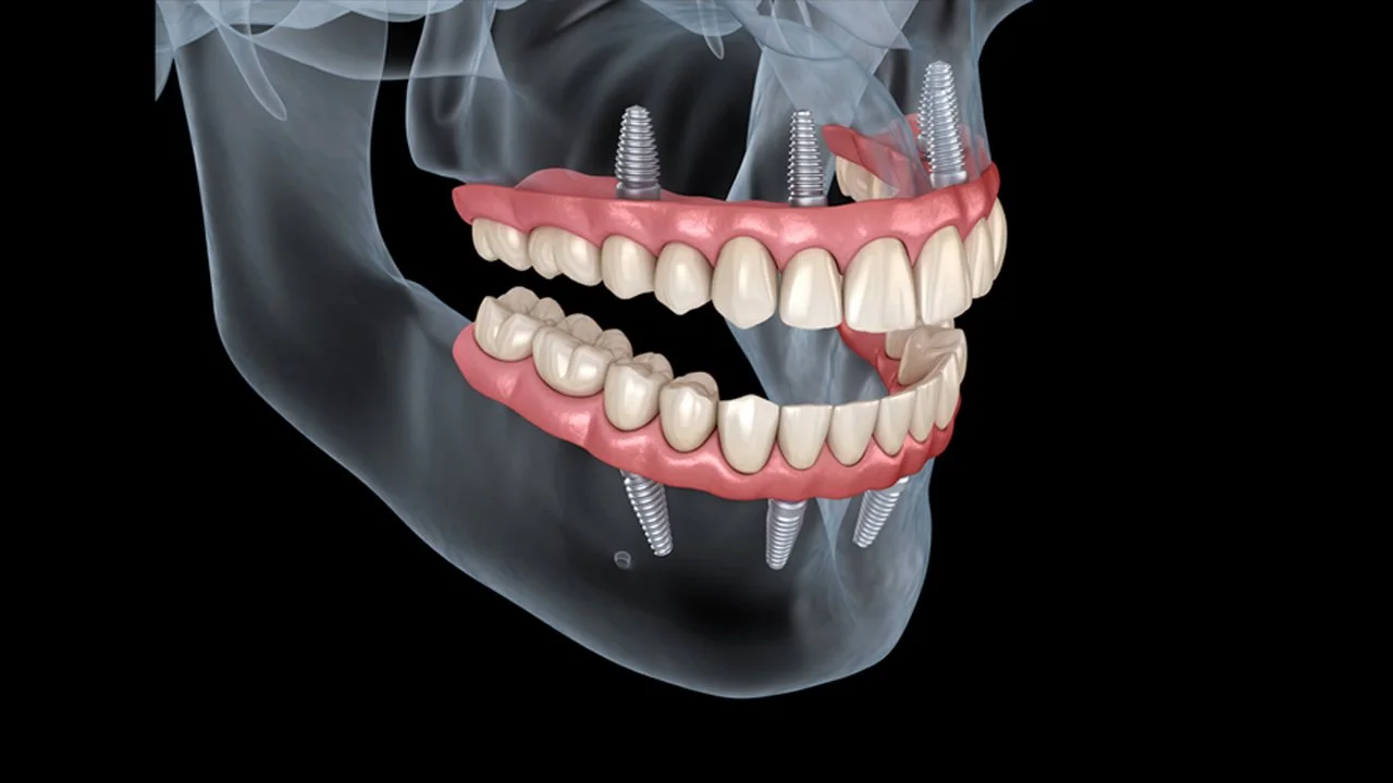 Dr Nadim Z. Baba - Updates on New Materials for the Restoration of Full Arch Rehabilitations (Copy)