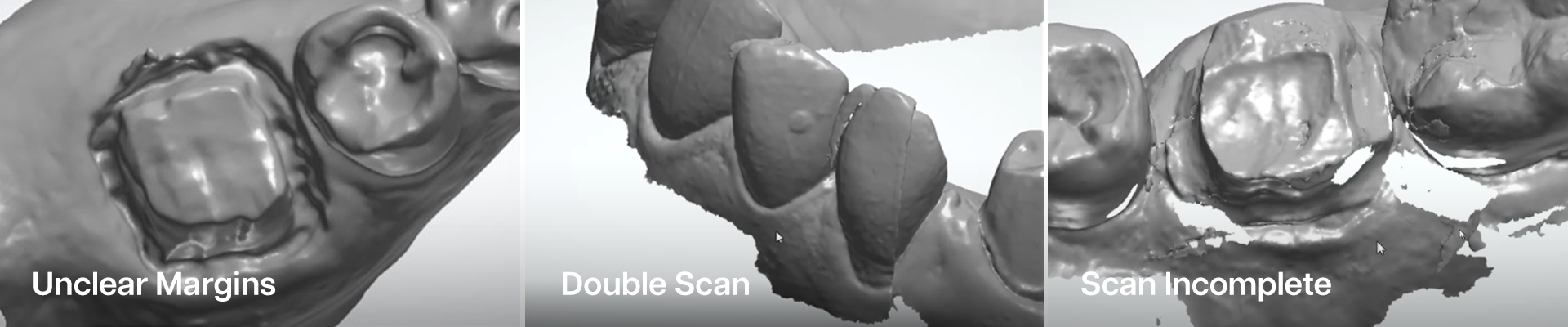 Intraoral scans that show examples of unclear margins, double scans, and incomplete scans.