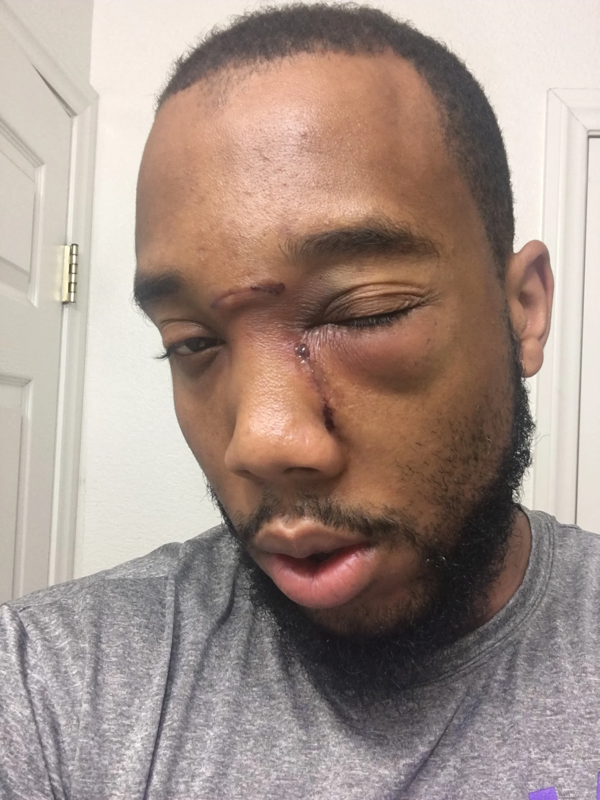 Post Neoplasm Surgery / Cancer Diagnoses 