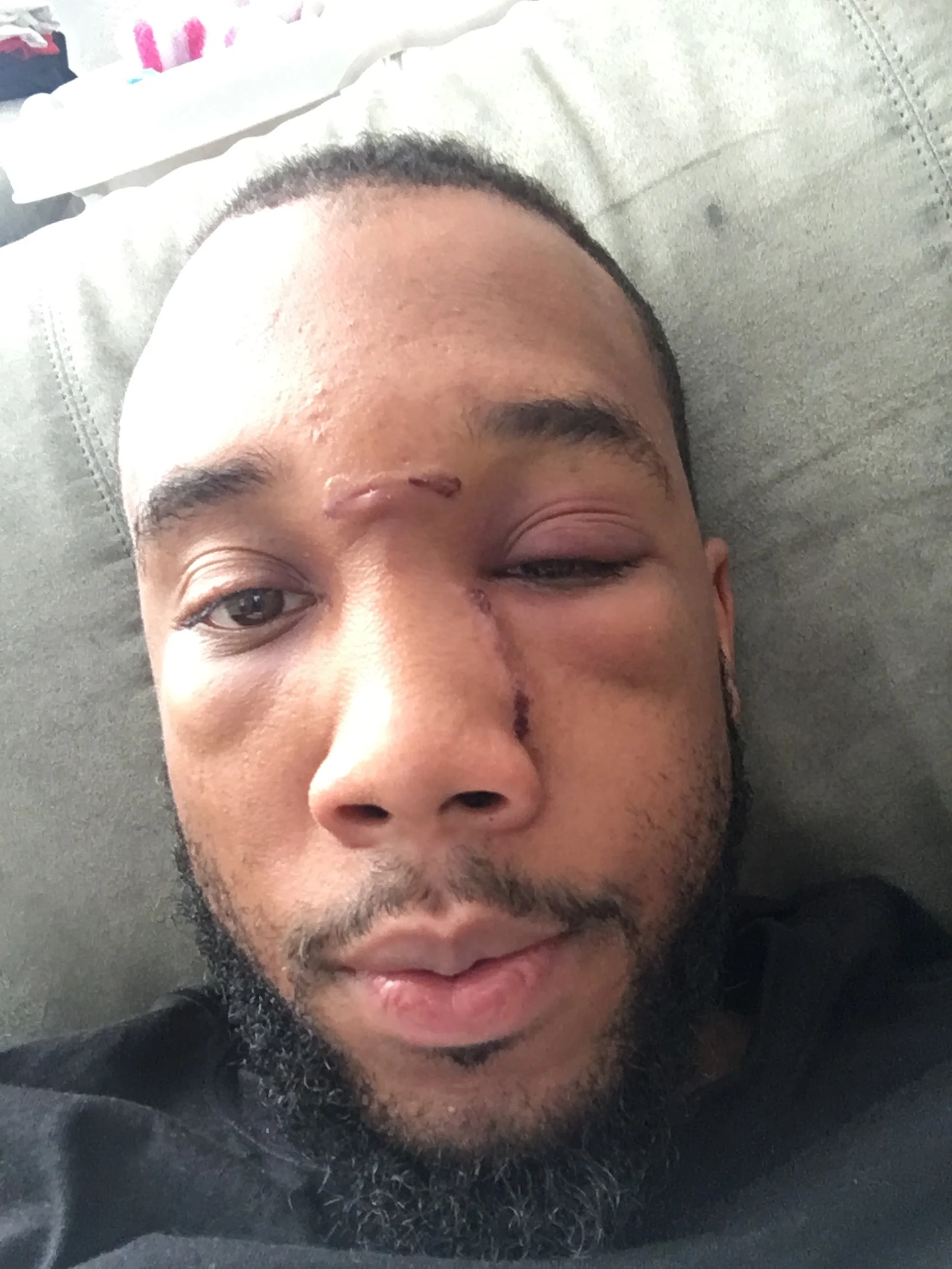 Post Neoplasm Surgery / Cancer Diagnoses 