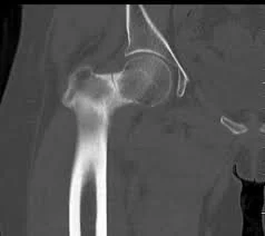 The little black line at the neck of the femur is a BIG problem... &nbsp;(image thanks to www.boneschool.com