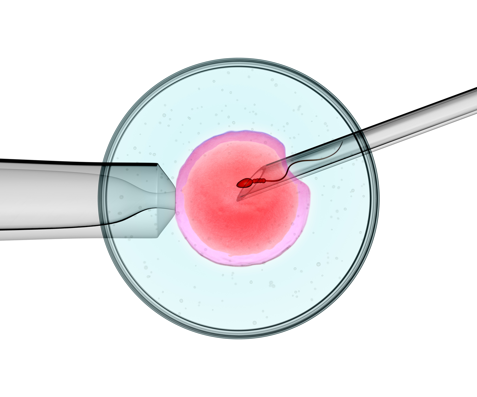 IVF WITH IMMUNE PROTOCOL UPDATES