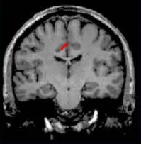 cingulatesulcus_coronal_image2.jpg