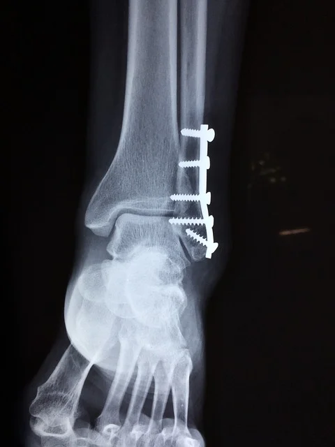 ankle-2253057_640.jpg