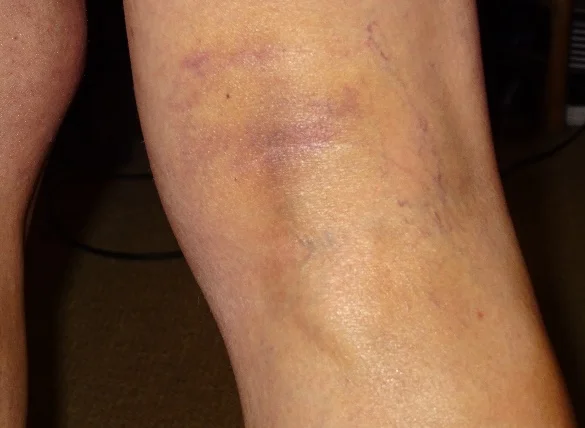 THE Running Biddy Hamstring