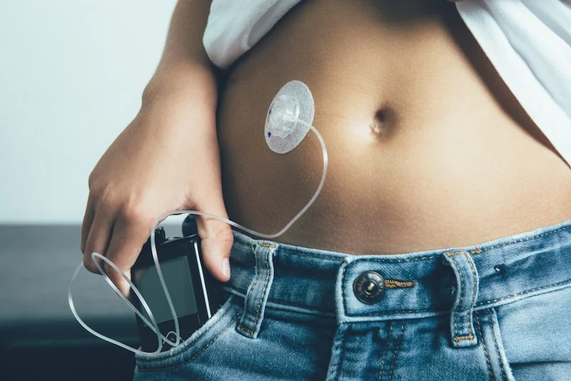artificial-pancreas-type-1-diabetes-insulin-pump-.jpg