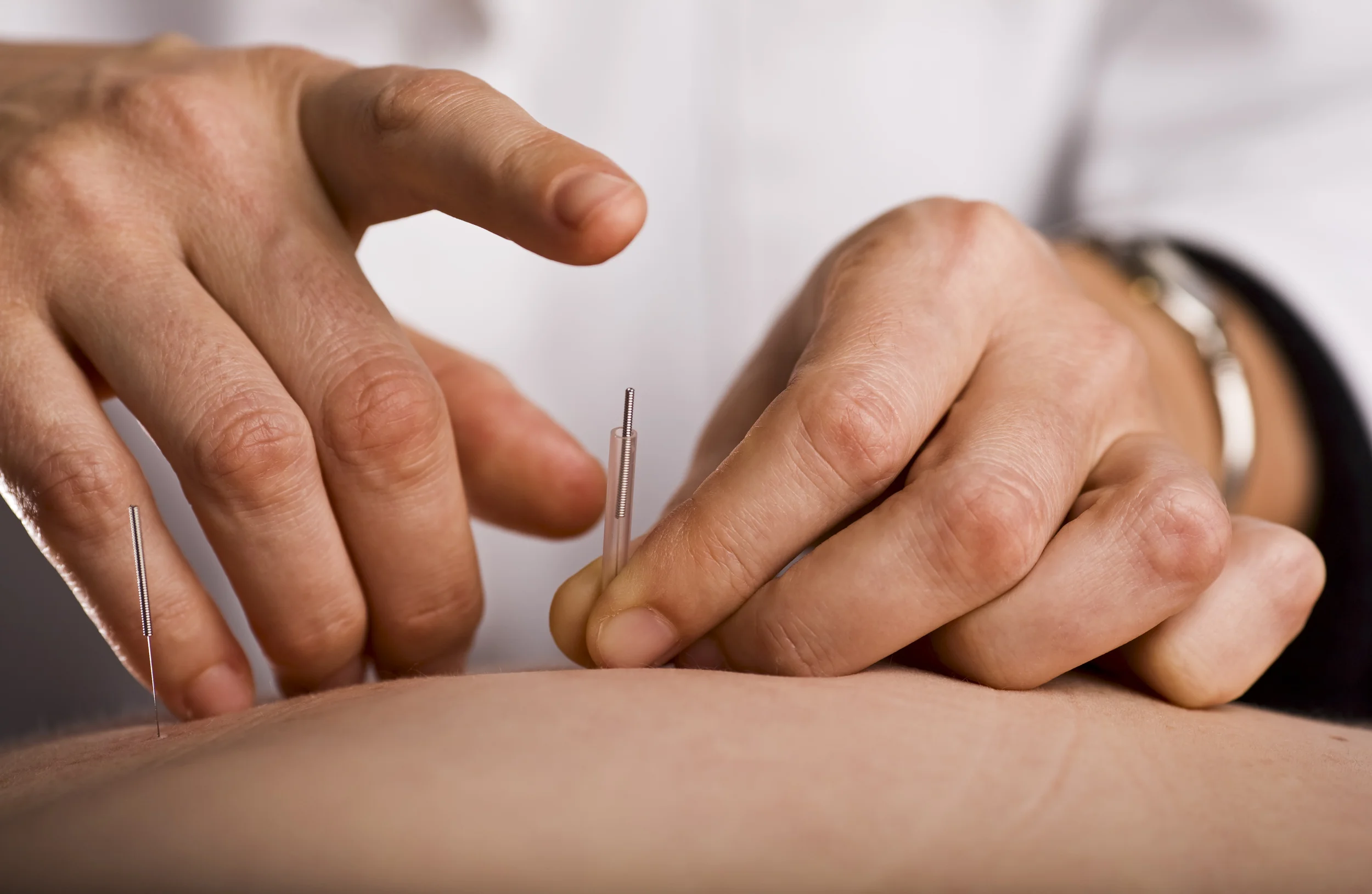 Acupuncture for Newbies