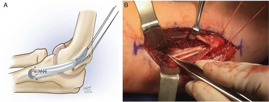 Illustration A and intra-operative photo B demonstrating the reconstructed MUCL ligament.